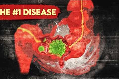 The #1 Disease More Common than Heart Disease and Cancer